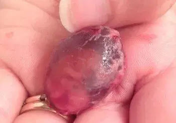 ตกเลือด